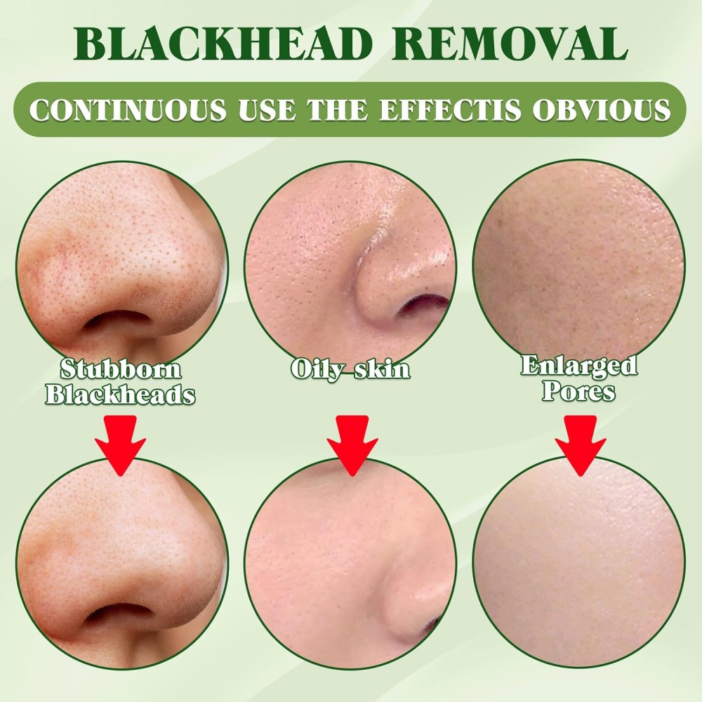 15 Pack Charcoal Blackhead Rem - Charcoal Pore Strip 评论和价格
